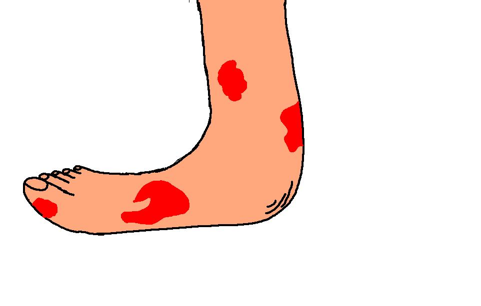 The 10 Plagues of Egypt Boils and Sores Lesson