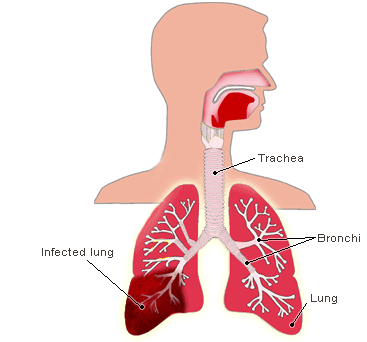 Pneumonia. Pneumonia