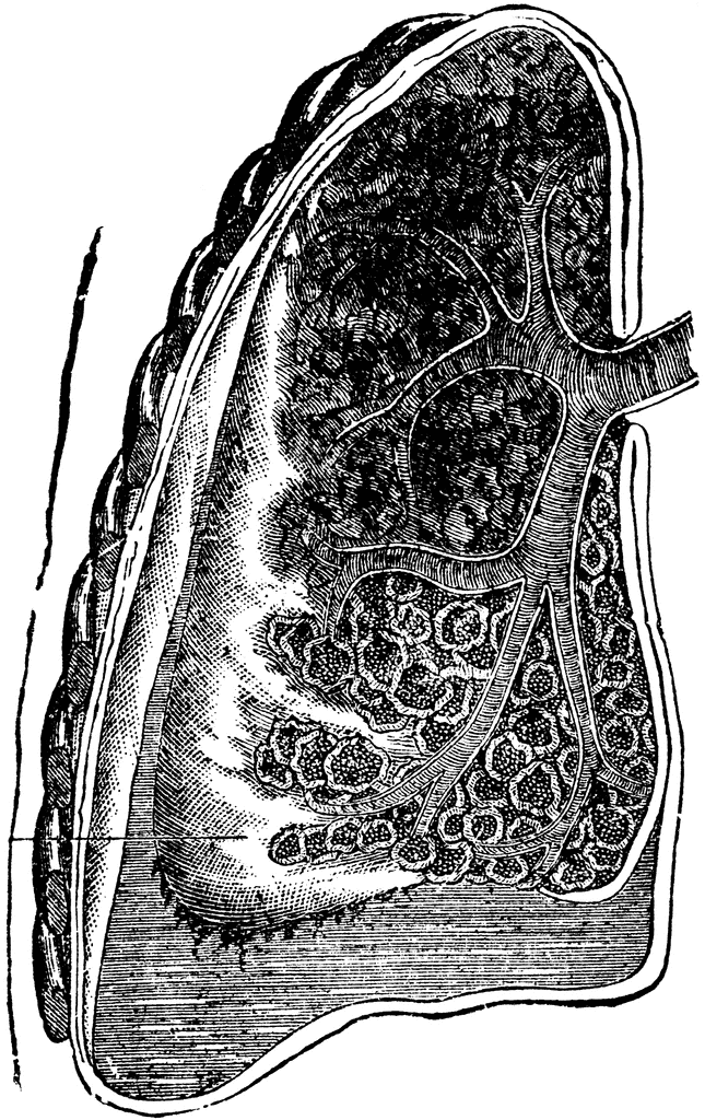 Lung with Pneumonia