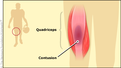 Quadriceps Contusion