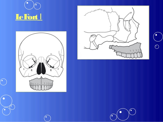 middle-face-fracture-8-638 