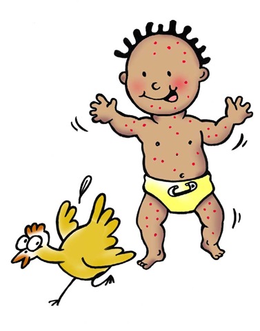 chicken pox baby cartoon - Clip Art Library
