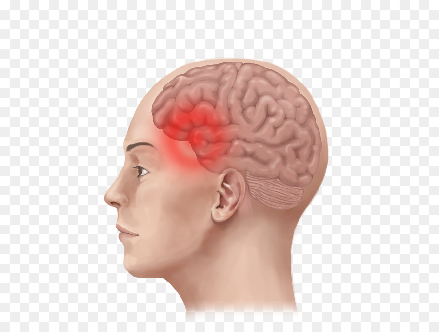 Migraine Tension headache Therapy - ear png download - 520*673 - Free Transparent  png Download.