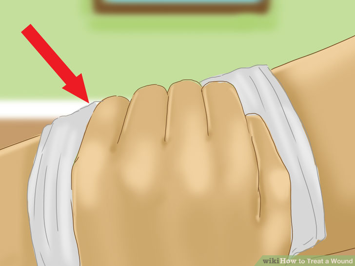 How to Treat a Wound 