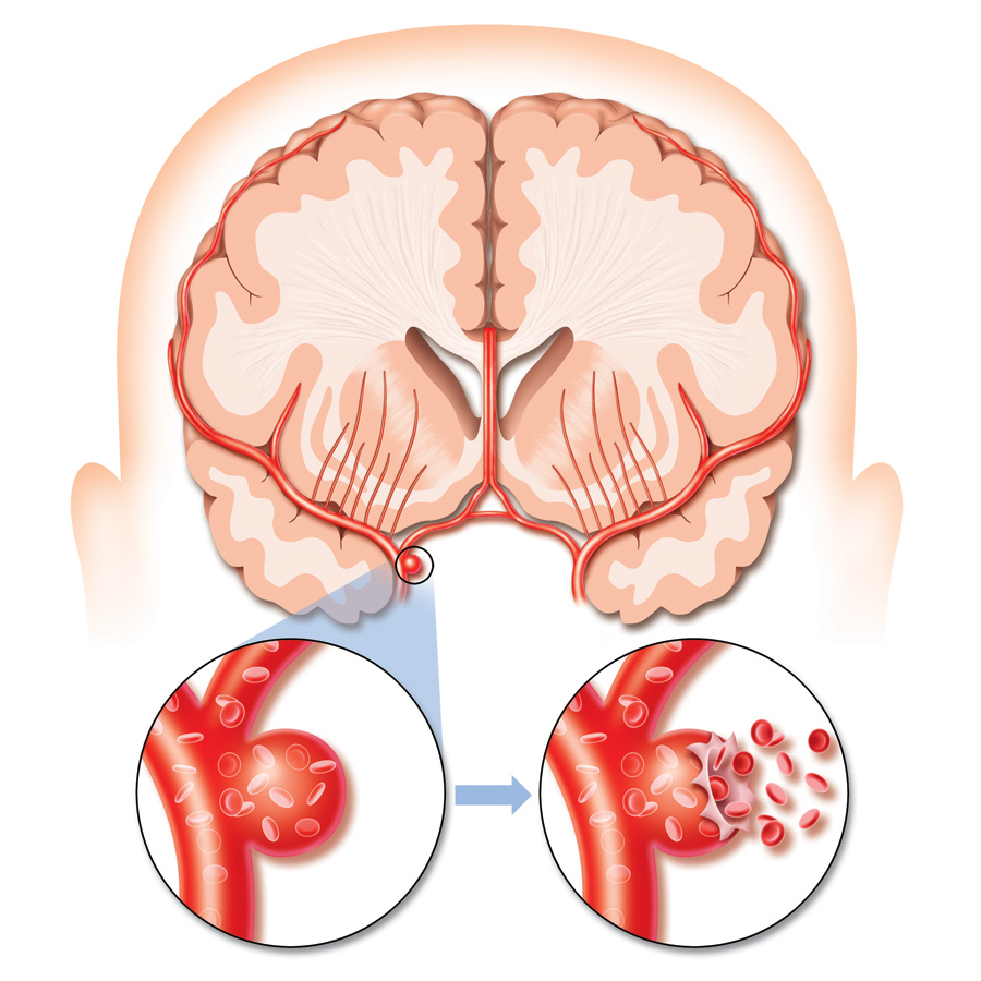 person having a stroke cartoon - Clip Art Library