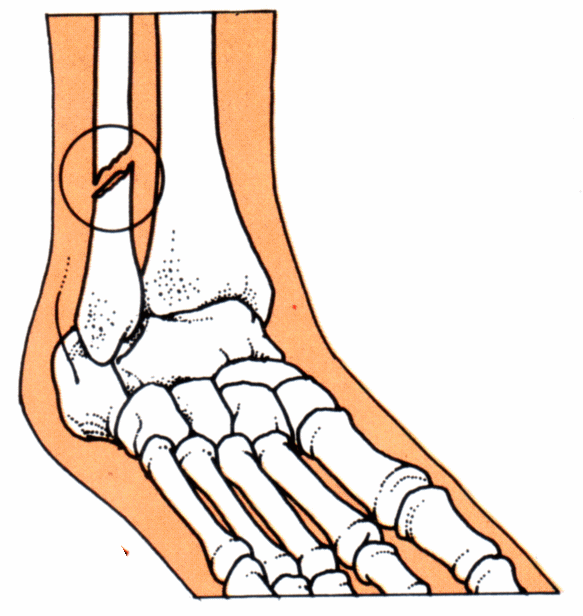Free Broken Ankle Cliparts, Download Free Broken Ankle Cliparts png