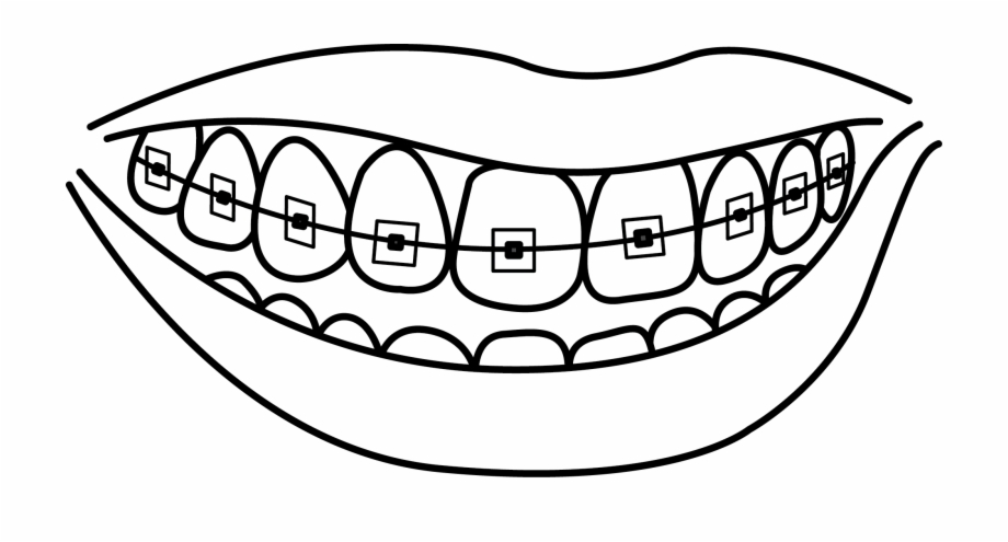 Image Free Stock Braces At Getdrawings Com Free