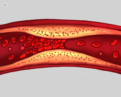 Illustration of atherosclerosis showing plaque buildup narrowing an artery and restricting blood flow.