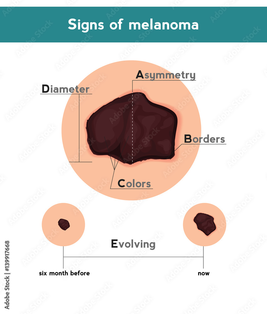 Signs of Melanoma: Early Detection Guide with Visual Examples