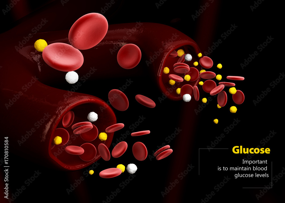 Hyperglycemia Stock Vector Illustration And Royalty Free - Clip Art Library