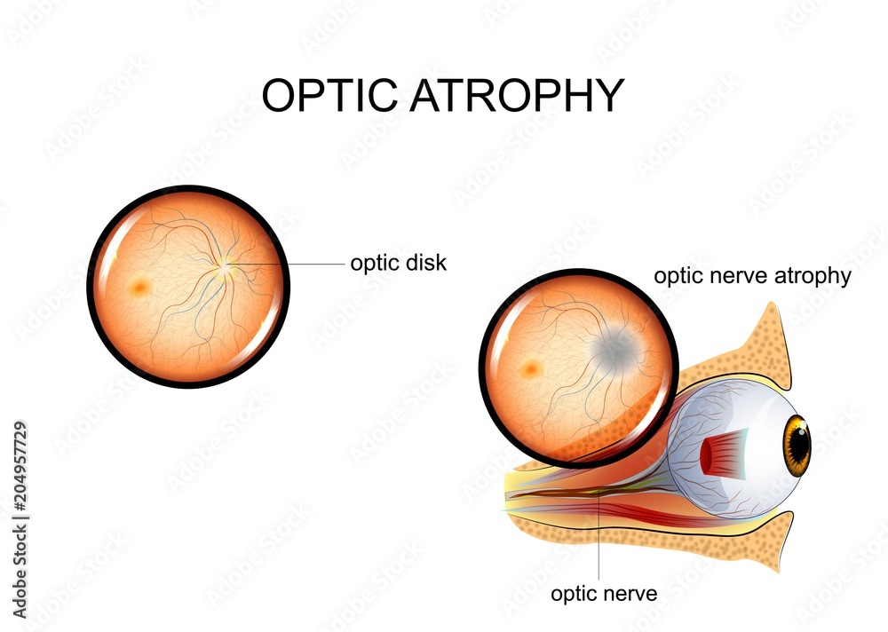 Medical illustration showing optic atrophy with labeled optic disk and optic nerve degeneration.