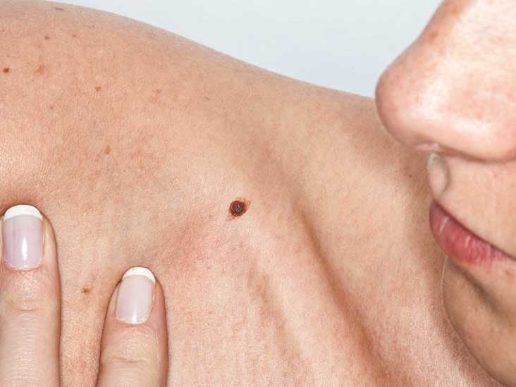 Identifying Suspicious Moles: When to See a Dermatologist