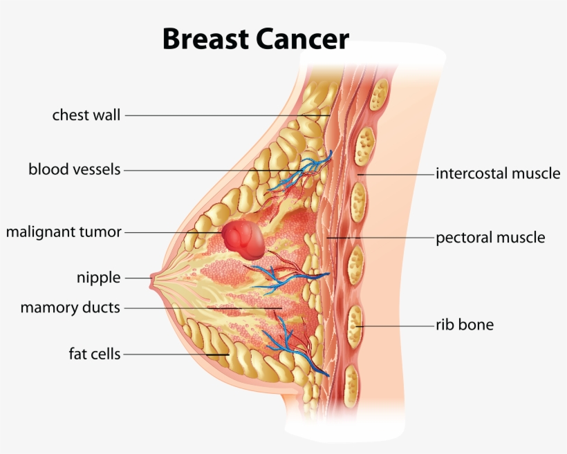Anatomical illustration of breast cancer showing malignant tumor, mammary ducts, nipple, fat cells, blood vessels, and surrounding chest structures.