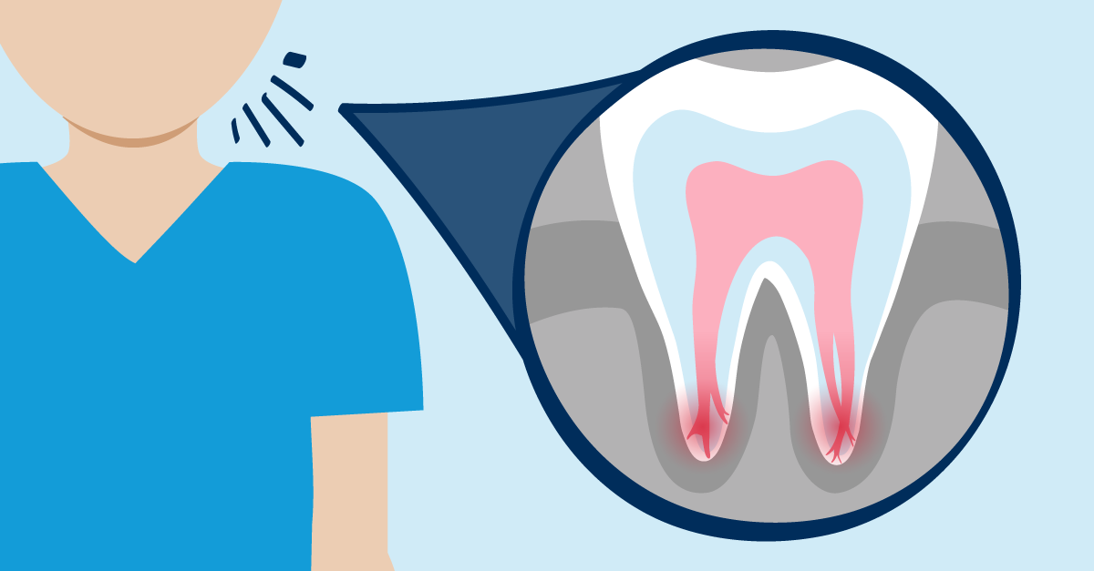 Illustration of a tooth cross-section showing inflamed pulp and root canals, indicating dental infection or abscess.