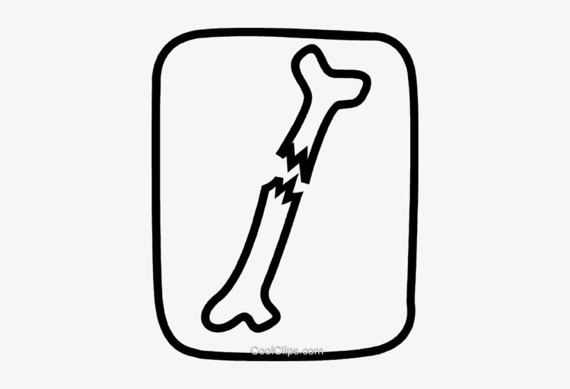 Broken Bones Clip Art Library 9453