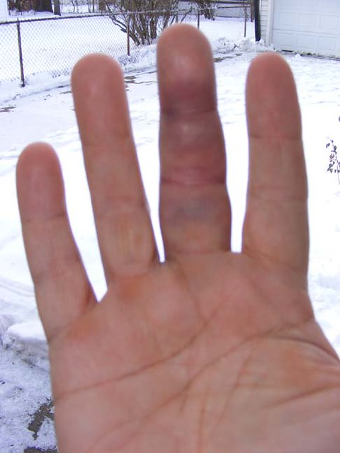 Hand with bruised middle finger against snowy background, showing discoloration and swelling.