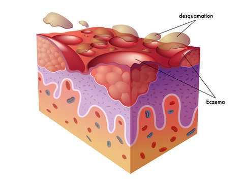 Understanding Skin Desquamation and Eczema: A Visual Guide