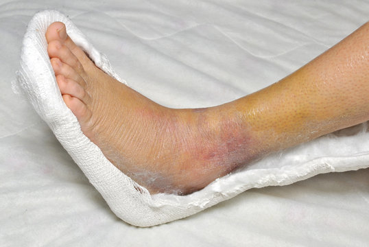 Swollen, bruised ankle wrapped in gauze on a white sheet, indicating injury or post-treatment care.