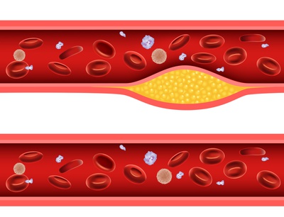 Illustration showing atherosclerosis with plaque buildup narrowing an artery, compared to a healthy vessel with free blood flow.