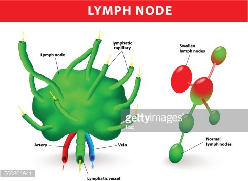 Diagram showing normal and swollen lymph nodes with labeled anatomy including arteries, veins, lymphatic capillaries, and vessels.