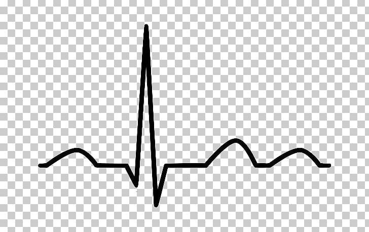 Hand-drawn ECG waveform showing a prominent QRS complex and baseline rhythm on transparent background.