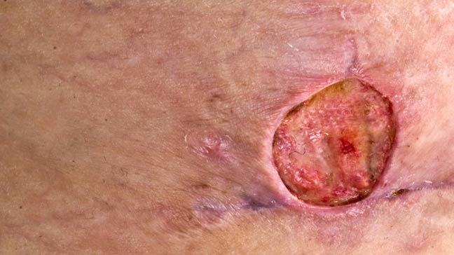 mrsa bacterias