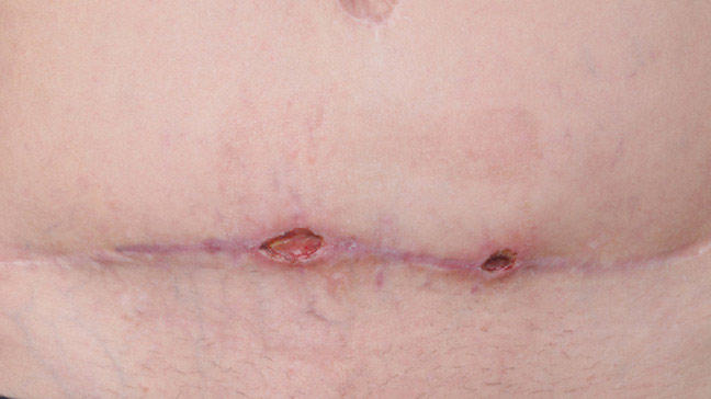 Abdominal surgical scar with two healing wound sites along a horizontal incision line.