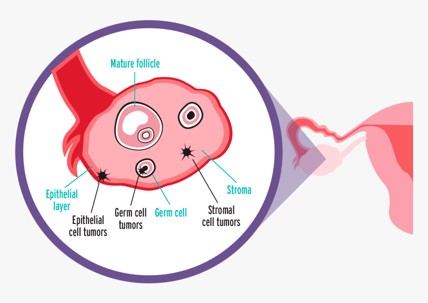Illustration of ovarian tissue showing mature follicle, germ cells, stroma, and various tumor types (epithelial, germ cell, stromal).