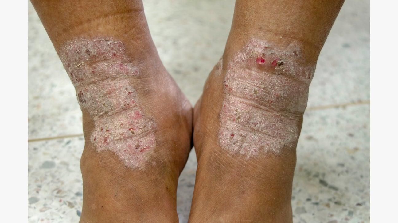 Close-up of both ankles showing severe psoriasis with thick, scaly plaques and red, inflamed skin.