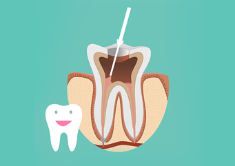 Free root canals, Download Free root canals png images, Free ClipArts ...