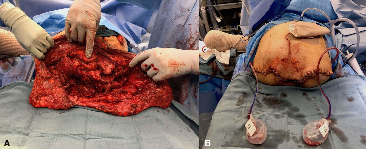 Evaluation And Management Of Crush Injuries Of The Foot