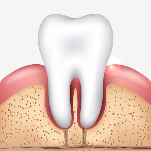 Cross-sectional illustration of a healthy tooth embedded in gum tissue and jawbone, showing enamel, dentin, pulp, and periodontal ligament.