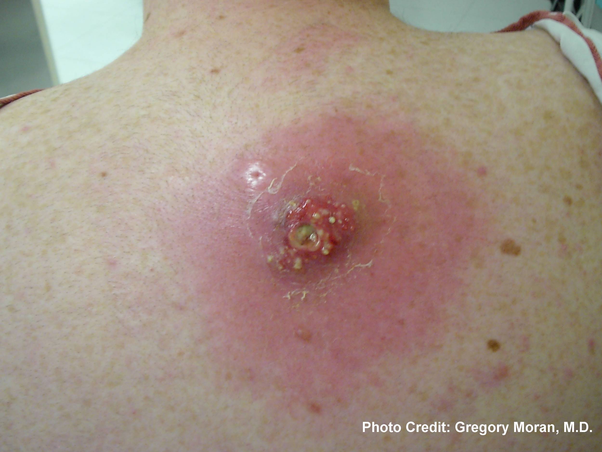 Ulcerative Skin Lesion with Central Necrosis - Clinical Image and Analysis