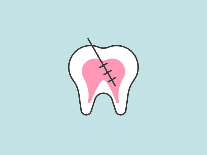 Illustrated tooth with pink pulp and black sutures indicating dental repair or root canal treatment.