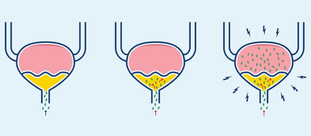 Illustration of bladder infection progression: normal bladder, bacterial colonization, and inflamed infected bladder with pain signals.