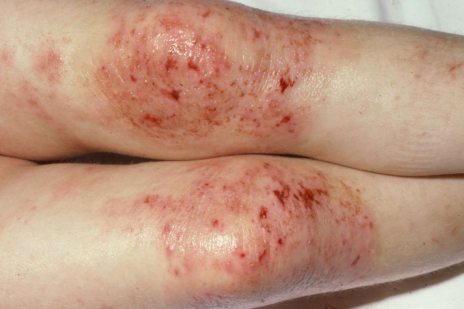 Severe eczema or atopic dermatitis presenting as red, inflamed, oozing patches on both knees.