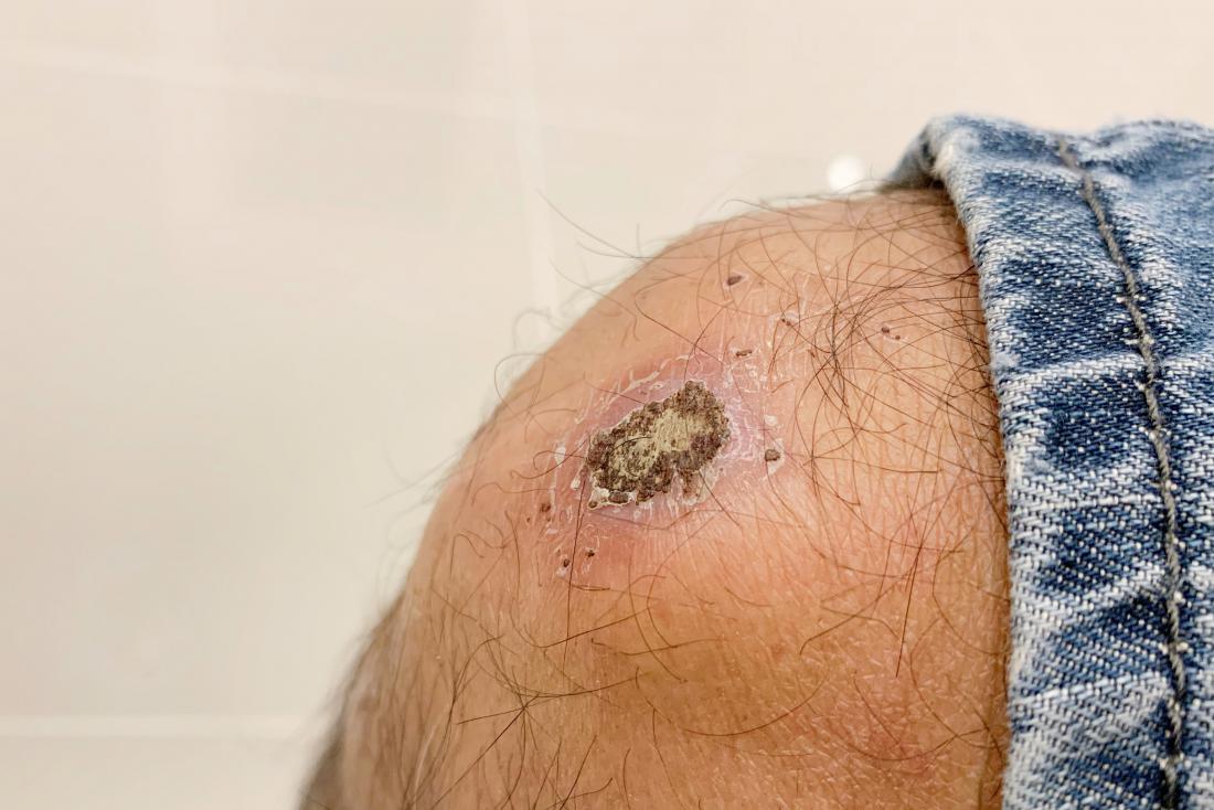 infected-scab-on-kneee-injured-accident-stock-photo-2084280616-clip