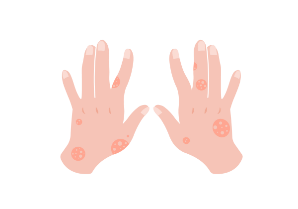 Illustrated pair of hands showing red circular rashes, possibly indicating a skin condition like ringworm or eczema.