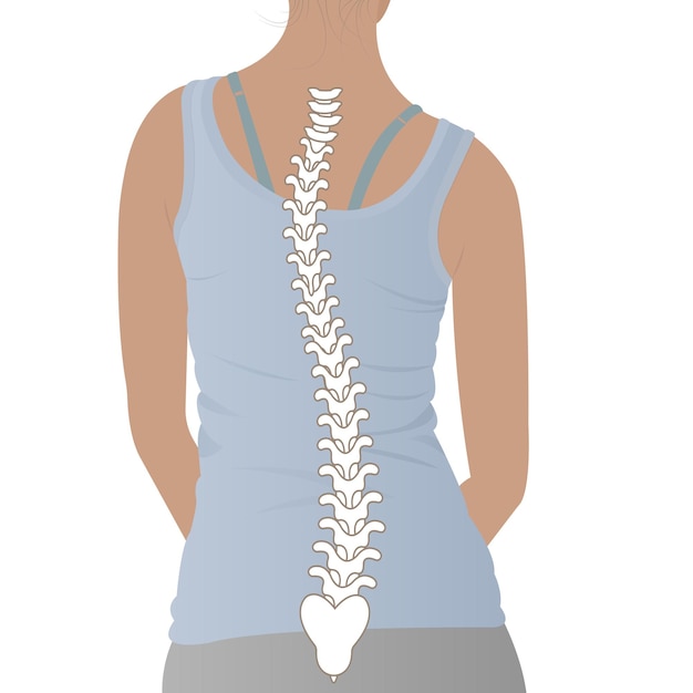 2,000+ Scoliosis Illustrations, Royalty-Free Vector Graphics - Clip Art ...