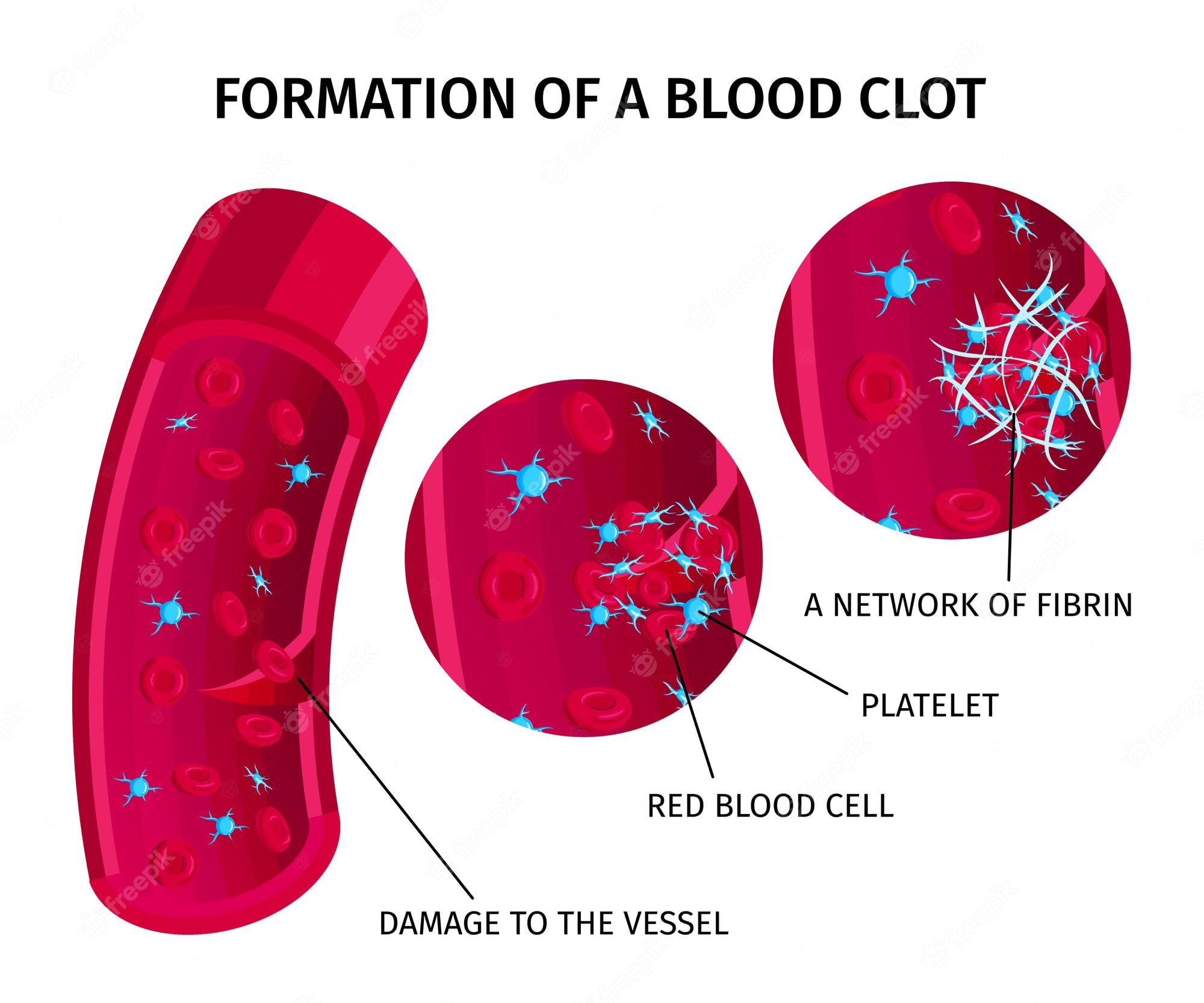 Illustration showing the three stages of blood clot formation: vessel damage, platelet aggregation, and fibrin mesh trapping red blood cells.