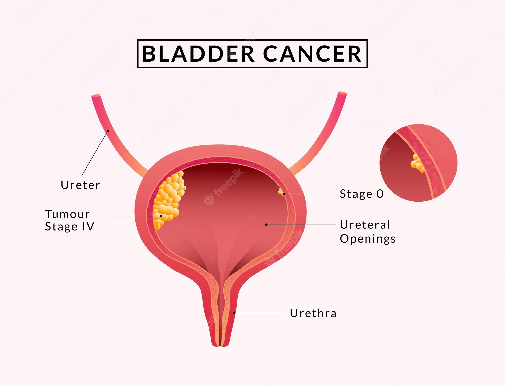 Bladder Cancer. Symptoms, Causes, Treatment. Line Icons Set - Clip Art ...