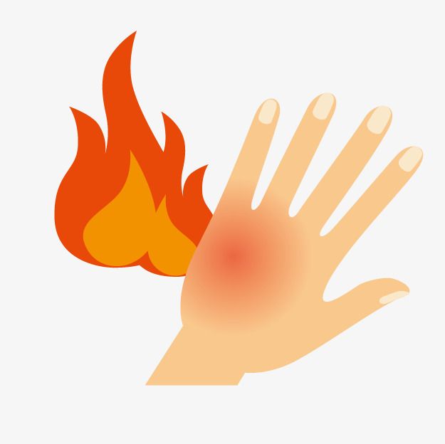Hand with red burn mark and flame icon indicating thermal injury or scald.