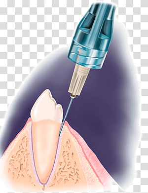 Dental anesthetic injection being administered into the gum near a tooth, illustrating local anesthesia in dentistry.