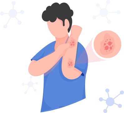 Illustration of a person with red, itchy skin rash on forearm, magnified view showing clustered lesions and surrounding virus-like particles.
