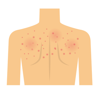 Illustration of a human torso showing red, inflamed skin lesions indicative of a dermatological condition.