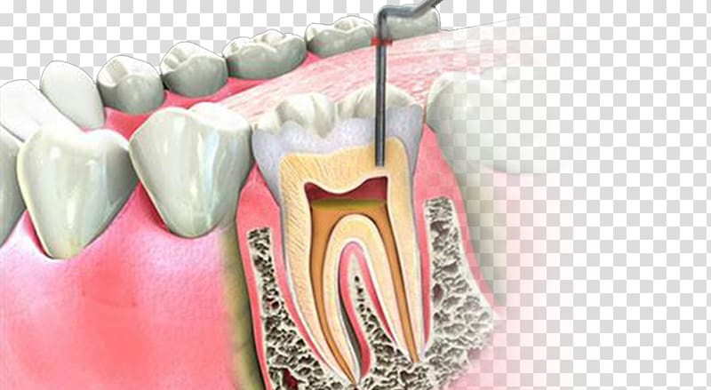 Medical illustration of a tooth undergoing root canal treatment with dental instrument inserted into the root canal.