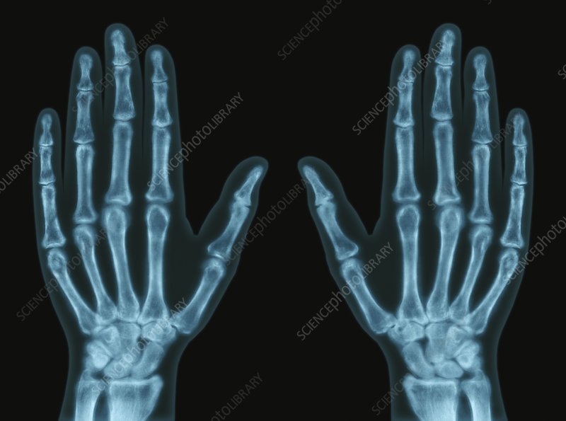 X-ray image of both human hands showing detailed bone structure against a black background.
