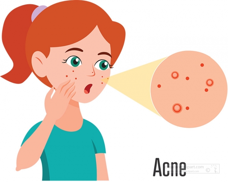 Acne Pimple Dermatology PNG, Clipart, Acne, Acne Cliparts, Area - Clip ...