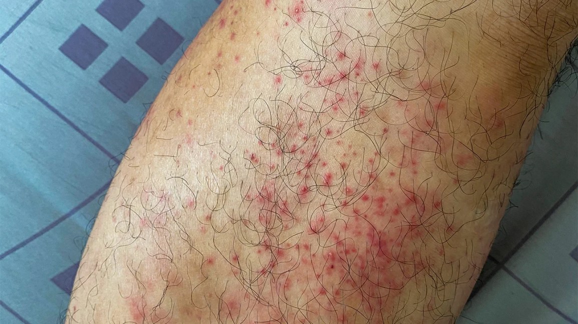 Itchy Legs And Rash