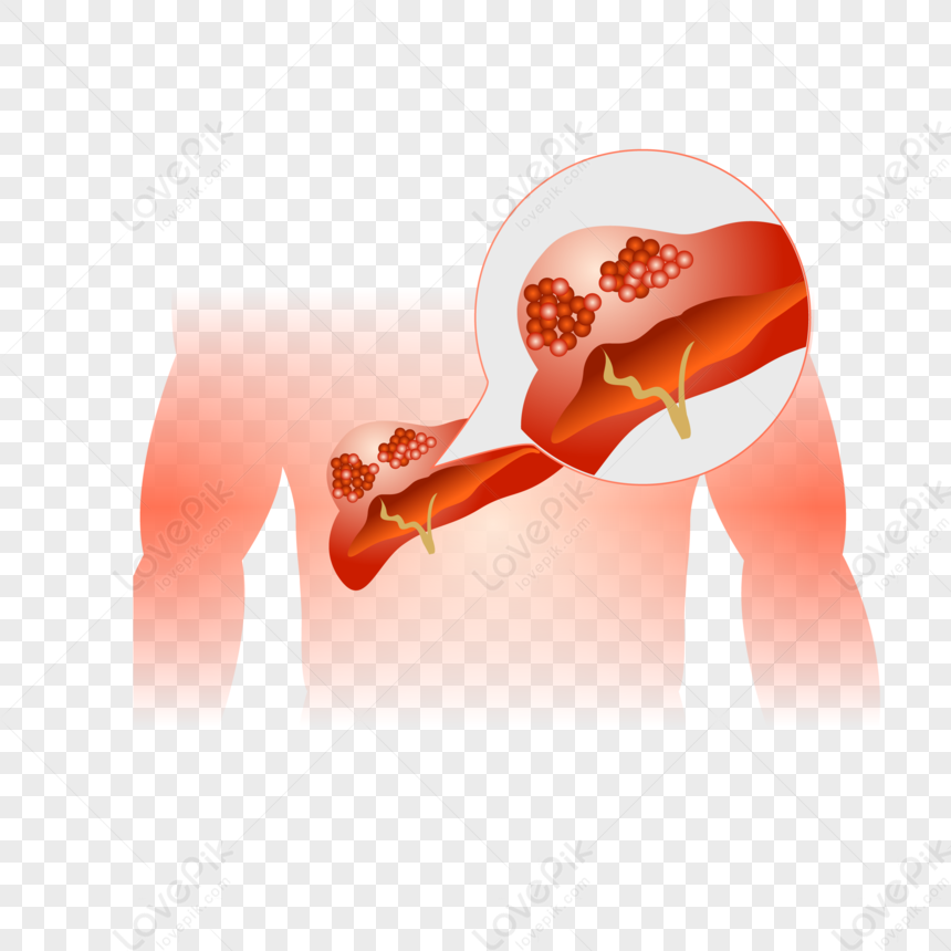 Illustration of arterial plaque buildup causing narrowed blood vessels and reduced blood flow.